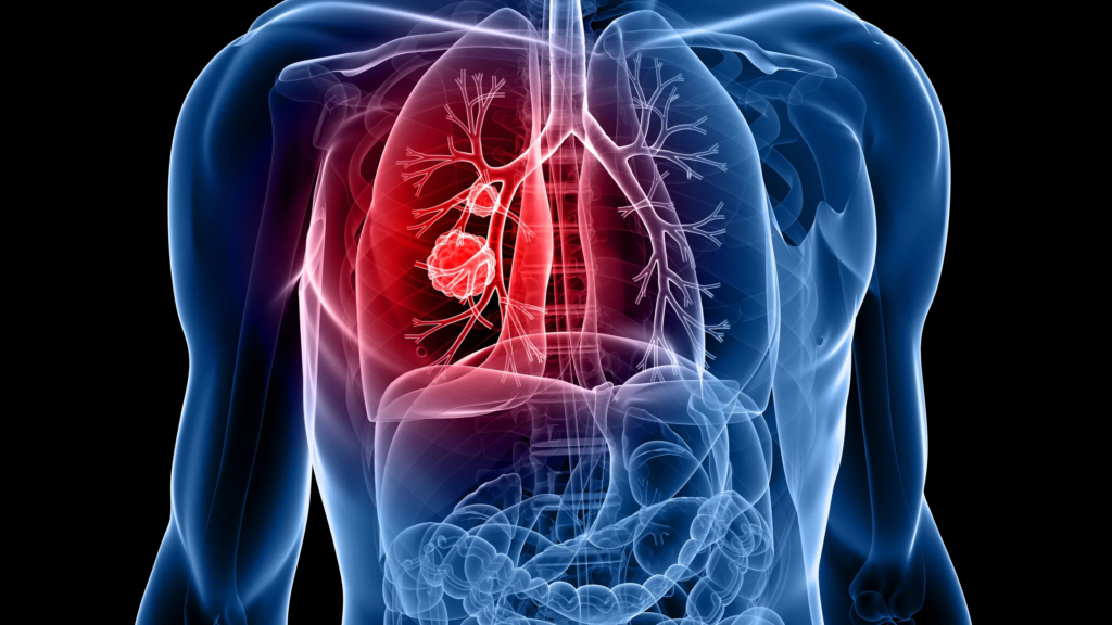 Lung Cancer use tiny magnetic robots for detection