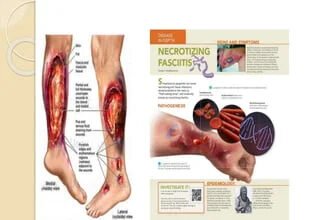 "flesh-eating" bacterial infection.